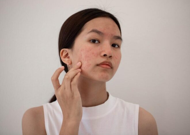 Editorial Harian Wanita – WAJIB DICATAT! Inilah 3 tips memilih tabir surya untuk kulit berjerawat!