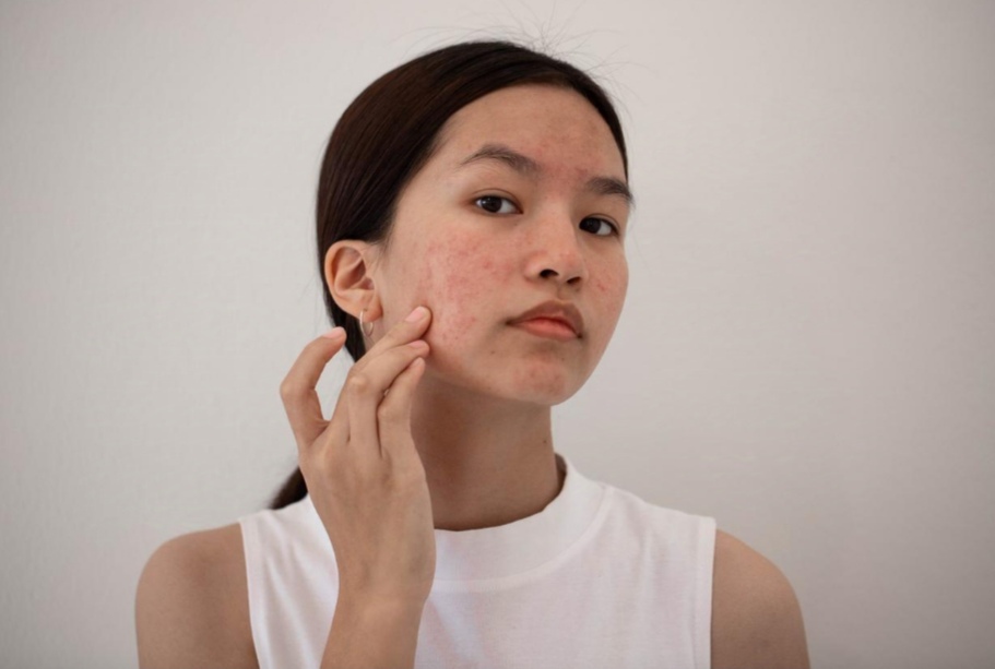 Editorial Harian Wanita – WAJIB DICATAT! Inilah 3 tips memilih tabir surya untuk kulit berjerawat!